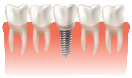 Implante dental